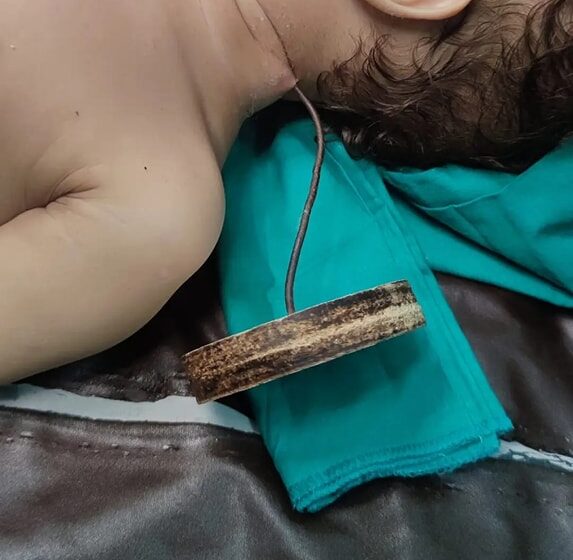 سيخ حديدي اخترق رقبته وصدره.. أطباء مستشفى الأحرار بالزقازيق ينقذون حياة طفل رضيع
